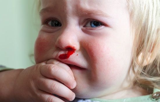 krwawienie z nosa dziecka, dziecko krwawienie, krwawienie z 