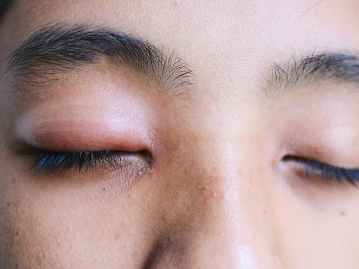 Eye Stye Infection