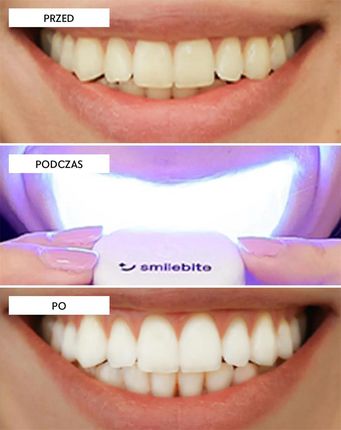 Smilebite Light & Bright urządzenie do wybielania zębów z nakładką LED i żelem wybielającym 1 szt. - zdjęcie 2