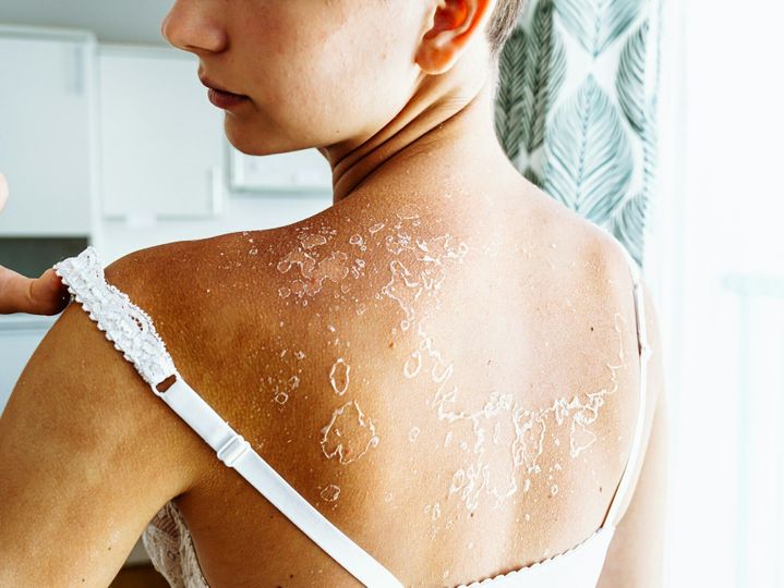 dry flaky skin on back of teenage girl