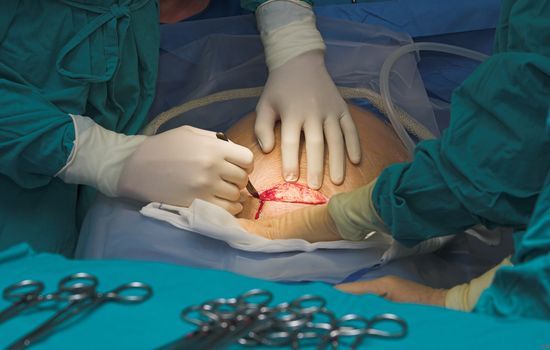 operacja w ciąży operacje podczas ciąży