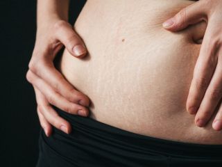 Usuwanie rozstępów: efekty. Jak pozbyć się rozstępów?