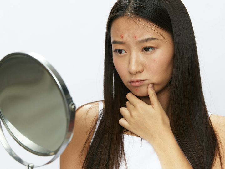 Asian woman with mirror in hand facial skin problems, acne and inflammation, red rash and allergies