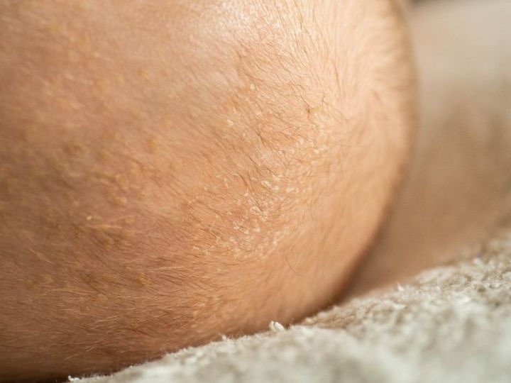 łojotokowe zapalenie skóry u niemowląt