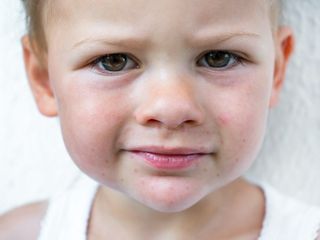 wysypka wokół ust u dziecka