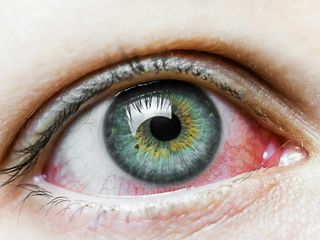 czerwone oczy u dziecka