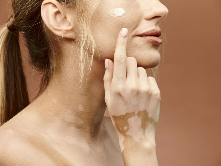 Young woman with vitiligo applies cream