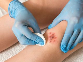 Plaster hydrokoloidowy: po co i jak stosować?