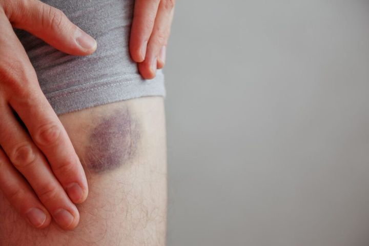 Bruise on leg. Injection bruises. Bruised wound injury and Bruised skin