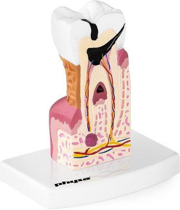 Physa Model Anatomiczny Chorego Zęba Człowieka W Skali 6 1