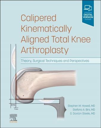 Calipered Kinematically aligned Total Knee Arthrop