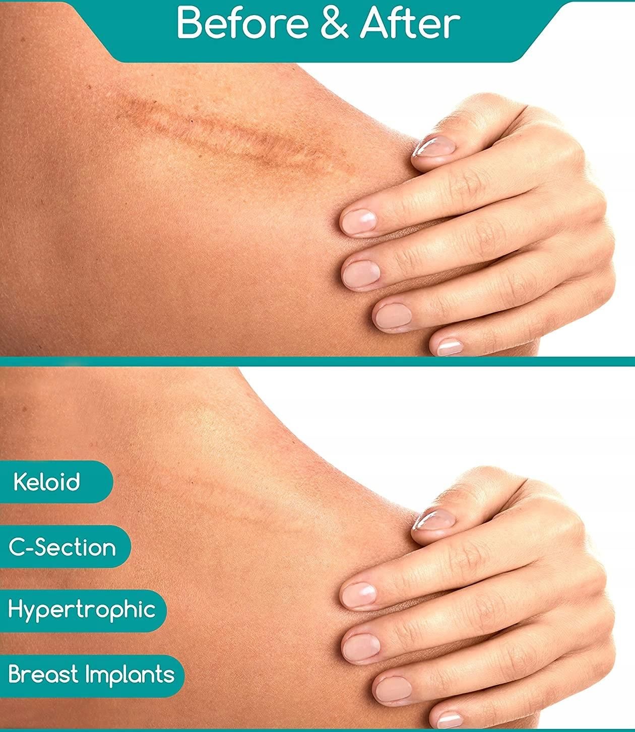 Plastry na blizny wielokrotnego użytku sylikonowe CC po cesarskim ...