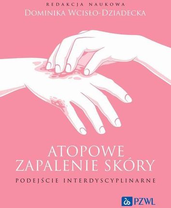 Atopowe zapalenie skóry Podejście interdyscyplinarne