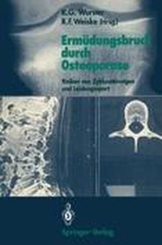 Erma1/4dungsbruch Durch Osteoporose: Risiken Von Zyklusstarungen Und ...