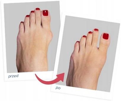 Aparat likwiduje Haluksy opaska separator FIT4MED - zdjęcie 2 Aparat likwiduje Haluksy opaska separator FIT4MED