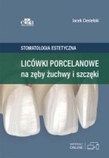 Licówki Porcelanowe Na Zęby Żuchwy I Szczęki. Stomatologia Estetyczna. 