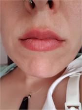 DermoFuture Hialuronowy wypełniacz ust 12ml